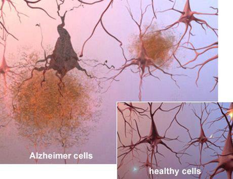 Amyloïd plaques Ophoping amyloïd buiten de zenuwcel in