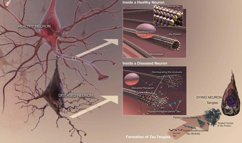 Tau kluwens Gezonde zenuwcel Gezond Tau-eiwit voor transportroutes in de cel Alzheimer zenuwcel Alzheimer