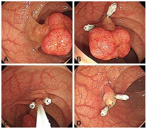 POST-POLIEPECTOMIEBLOEDING EN THIENOPYRIDINES ESGE guidelines.