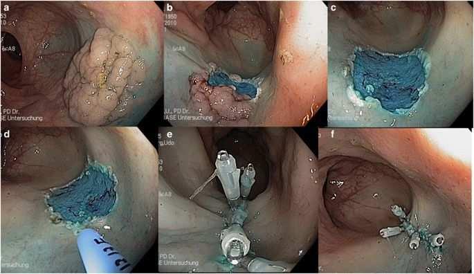 POST-POLIEPECTOMIEBLOEDING EN THIENOPYRIDINES ESGE guidelines.