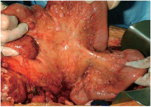 Incidentie Nr 2 peritoneaal metastasen (peritonitis carcinomatosis) Lemmens et al.