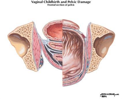 Risicofactoren voor fecale incontinentie - obstetrische traumata/ anale sfincter (OASI) en pudendus beschadigingen BMJ 2010, Jul 9: Obstetric anal sphincter injuries/ Ceska Gynekol 2010 Aug.