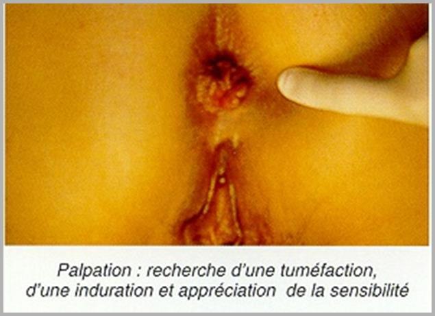 hemoroïden, episiotomie) - Descendum perineum -