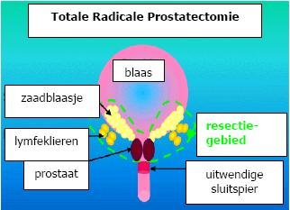 Bij een da Vinci prostatectomie wordt de prostaat weggenomen, samen met het omliggende weefsel, het stuk plasbuis dat doorheen de prostaat loopt, een deel van de blaasuitgang, een gedeelte van de