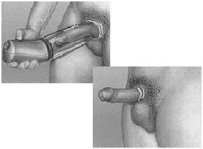 De vacuümpomp bestaat uit een kunststof cilinder die over de penis wordt geplaatst en waarbij een vacuüm ontstaat wanneer de lucht uit de cilinder wordt weggezogen.