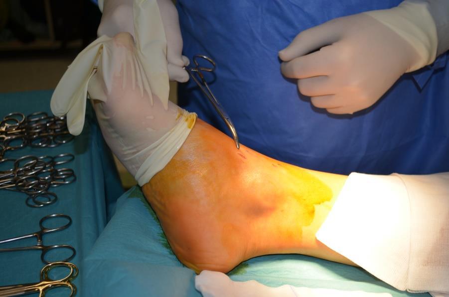 Anatomische merkpunten voor incisie
