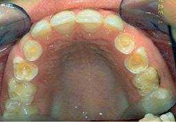 tandglazuur en vervolgens zelfs het blootliggende tandbeen oplossen. Eenmaal weggesleten tandglazuur komt niet meer terug. Hoe ziet tanderosie eruit? Tanderosie ziet u pas in een vergevorderd stadium.