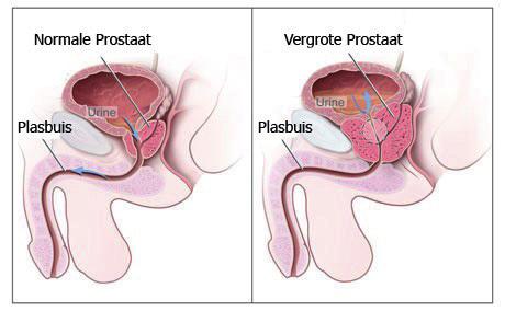 De ingreep die hiervoor wordt verricht, wordt TURP genoemd (Trans Urethrale Resectie Prostaat). Trans urethraal betekent dat de operatie via de plasbuis (urethra) wordt uitgevoerd.