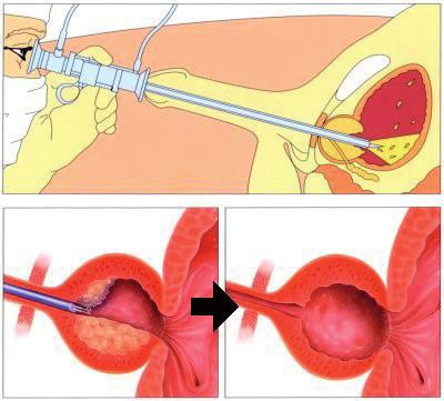 Wat gebeurt er bij de operatie? De uroloog brengt een instrument, een cystoscoop, in via uw plasbuis,. Hiermee kan de prostaat worden bekeken.