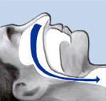 Snurken en obstructief slaapapneu syndroom Een mogelijke oorzaak van excessieve hypersomnolentie