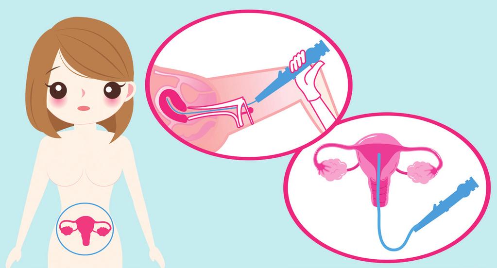Wat is een diagnostische hysteroscopie? Bij een diagnostische hysteroscopie kijkt de gynaecoloog met een kijkbuis (hysteroscoop) via de schede (vagina) naar de binnenkant van de baarmoeder.