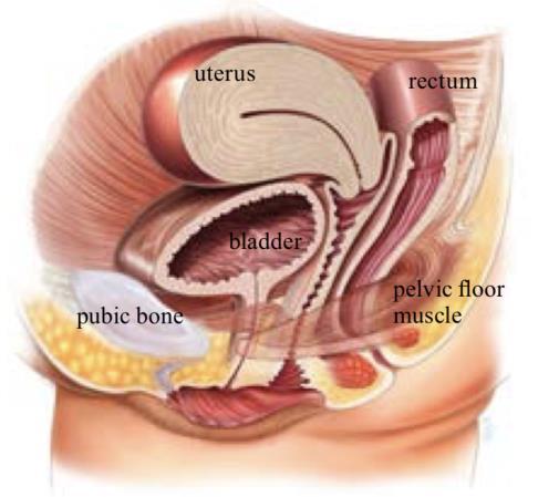 Prolaps (verzakking) van de baarmoeder en/of vaginawanden is een veel voorkomende aandoening waar tot wel 50% van de vrouwen mee te maken krijgt.