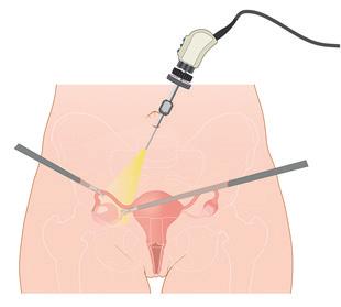 Uterus Eileider Eierstok Bij een laparoscopische operatie ziet de arts doorgaans de eileiders, de eierstokken en het bovenste deel van de baarmoeder (het baarmoederlichaam, corpus uteri).