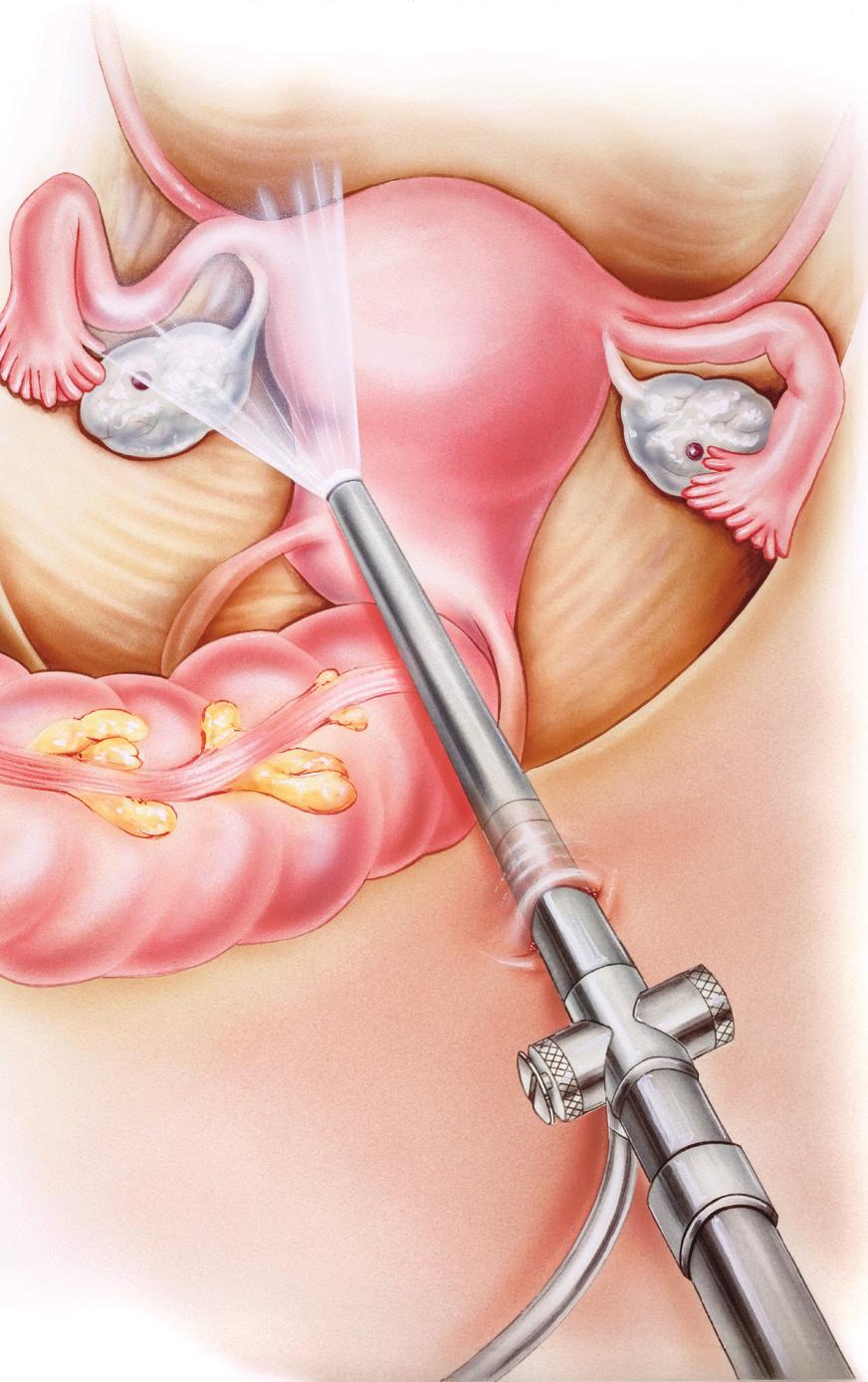 Verklevingen Verklevingen (adhesies) kunnen ontstaan door ontstekingen, vroegere operaties of endometriose. Meestal geven ze geen klachten en is een operatie niet nodig.