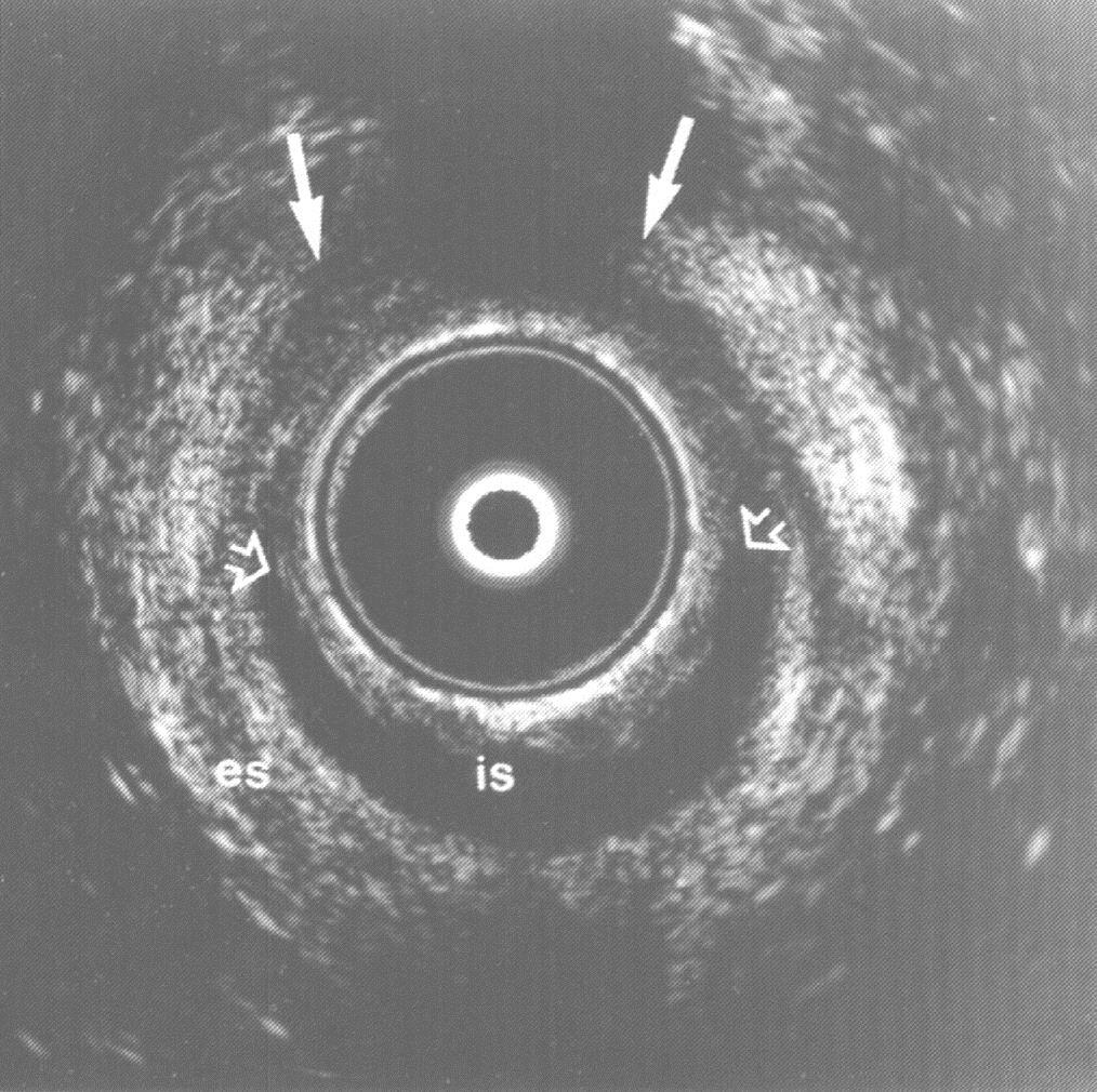 Endoanale