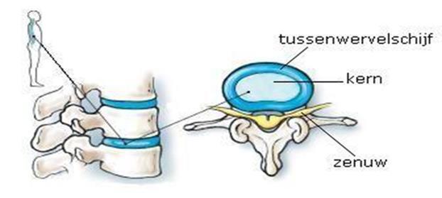 Wat is een transforaminale epidurale infiltratie? Een epidurale infiltratie is een inspuiting van een product in de epidurale ruimte.