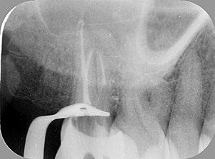Op de röntgenfoto is een laterale en apicale radiolucentie te zien aan de mesiobuccale radix en een perforatie halverwege de mesiale radix met extrusie van vulmateriaal (afbeelding 1).