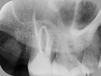 7 Lengtefoto van het 4 e kanaal toont een apart foramen apicale. Afb.