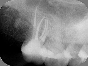 Casus 2 Een 35-jarige vrouw bezoekt haar tandarts met het verzoek een frontelement te bleken, omdat dit er geel uitziet (afbeelding 14).
