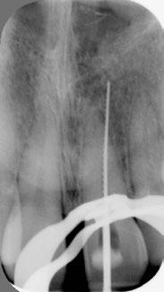 Nadat een röntgenopname is gemaakt, constateert de tandarts een perforatie (afbeelding 16), die naar zijn zeggen al eerder door de vorige behandelaar