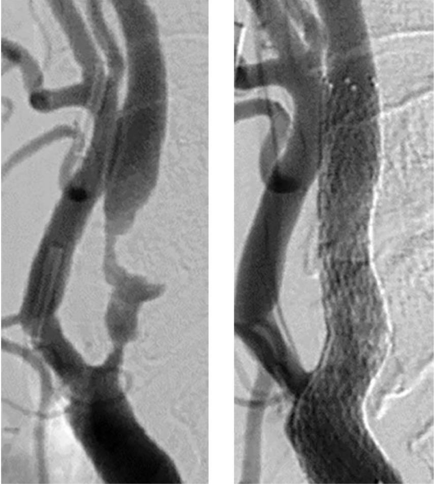 Stenting van een ACI