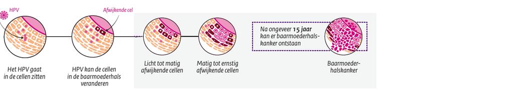 Voorstadia van baarmoederhalskanker Afbeelding 2. Ontwikkeling van baarmoederhalskanker Afwijkende cellen kunnen zich op den duur tot een voorstadium van baarmoederhalskanker ontwikkelen.