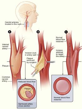 4 BEHANDELING De carotisendarteriëctomie wordt al lang toegepast met goede resultaten op lange termijn. Deze ingreep gebeurt onder volledige narcose.