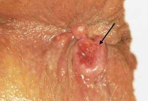 THERAPIE? 1. Anaal carcinoma, biopt 2. Chronische fissuur, zalf 3.