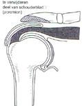 De operatie Tijdens de arthroscopie wordt eerst het schoudergewricht aan de binnenzijde bekeken.