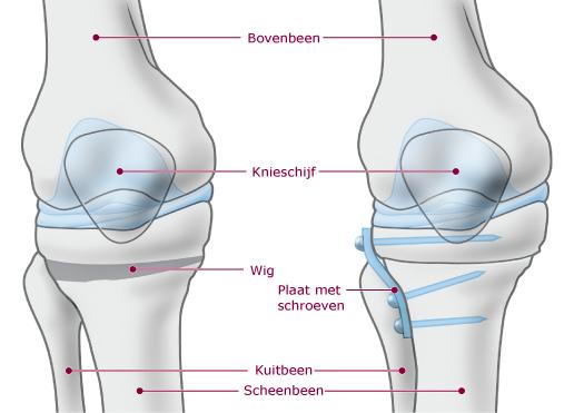 naar de gezonde kant van je knie waardoor je pijnklachten afnemen. De chirurg maakt een snee aan de voorkant van je scheenbeen, net onder je knie.
