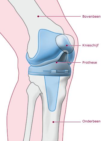 Een knieprothese bestaat in principe uit 3 delen: 2 van metaal en 1 van hard plastic. De chirurg zet de metalen delen vast in je boven- en onderbeen. Het deel van plastic komt ertussenin.