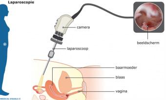 De operatie zelf Een lege blaas biedt meer ruimte tijdens de laparoscopie. Daarom plaatst men een sonde in de blaas. Langs dit slangetje wordt de urine afgevoerd.