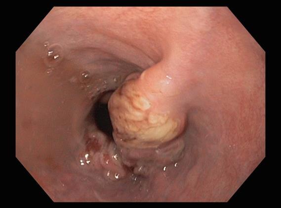 Diagnostiek: Gastroscopie Bevestigen weefseldiagnose middels biopten adenocarcinoom/
