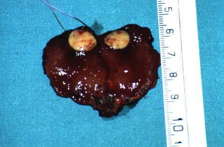 Medulair schildkliercarcinoom 2-5 % van de schildklierkankers Parafolliculaire cellen (calcitonine) Vroege metastasiëring naar