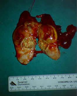 Anaplastisch carcinoom 3 % van alle schildklierkankers Snel groeiende tumor Oudere vrouwen Ingroei in spieren, trachea,
