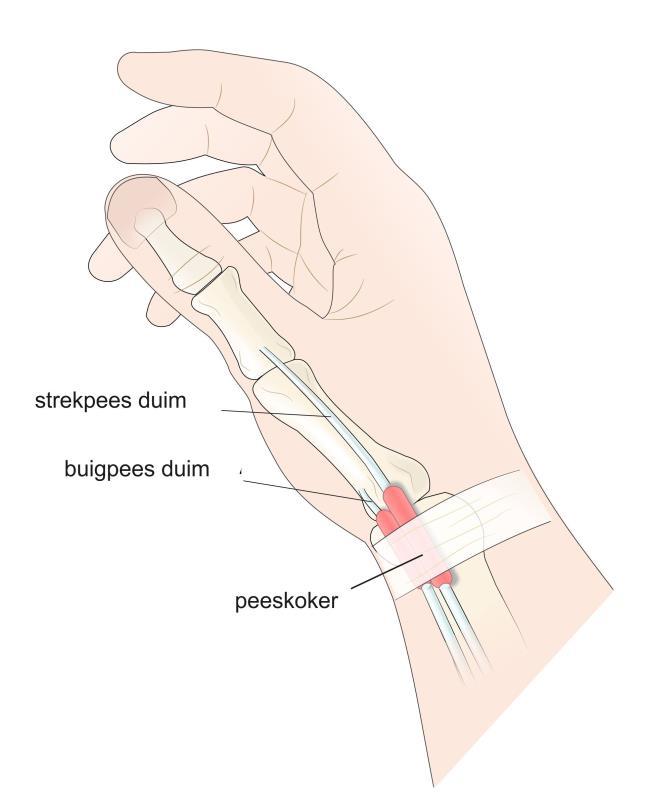 Afbeelding 2: Peeskoker rondom de pezen van de duim Na de operatie U blijft na de operatie nog een tijdje op de polikliniek plastische chirurgie, zodat we uw