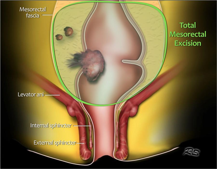 - Meenemen van mesorectale fascie TME: