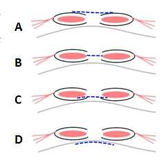 In dit plaatje ziet u op welke plaatsen een kunstof matje kan worden geplaatst (zie de stippellijnen). Bij een kijkoperatie komt het matje onder de spieren en in de buik te liggen (D).