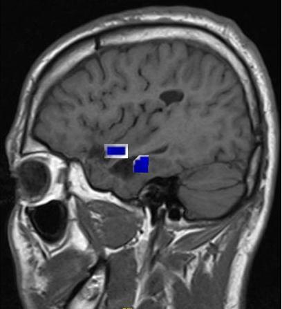 Er werden zowel ictale als interictale epileptiforme ontladingen gedetecteerd ter hoogte van de rechter hippocampale diepte elektrode.