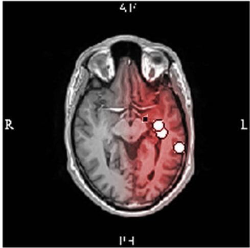 Het resultaat van de bronlokalisatie toonde een scattering van dipolen bij MEG en HD-EEG, waardoor er niet kon overgegaan worden tot het lokaliseren van de epileptogene zone.