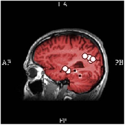 Fig.18: A: axiale doorsnede. B: coronale doorsnede. C: saggitale doorsnede. Wit = dipolen van MEG. Zwart = maxima van de distributies van HD-EEG.