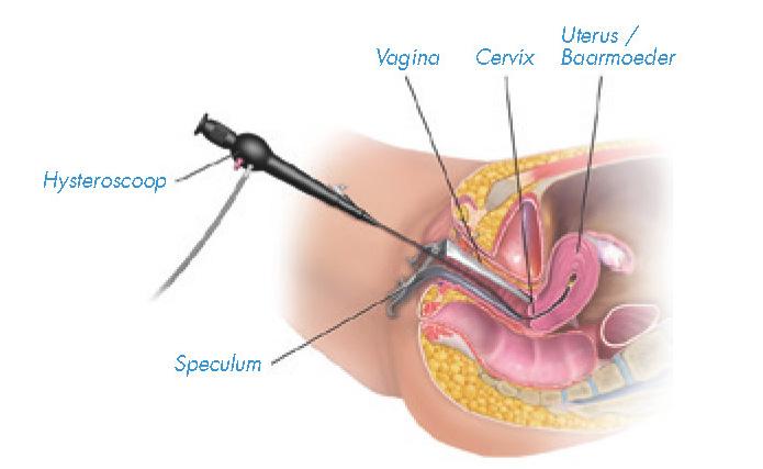WAT IS EEN HYSTEROSCOPIE? Hysteroscopie betekent letterlijk in de baarmoeder kijken.