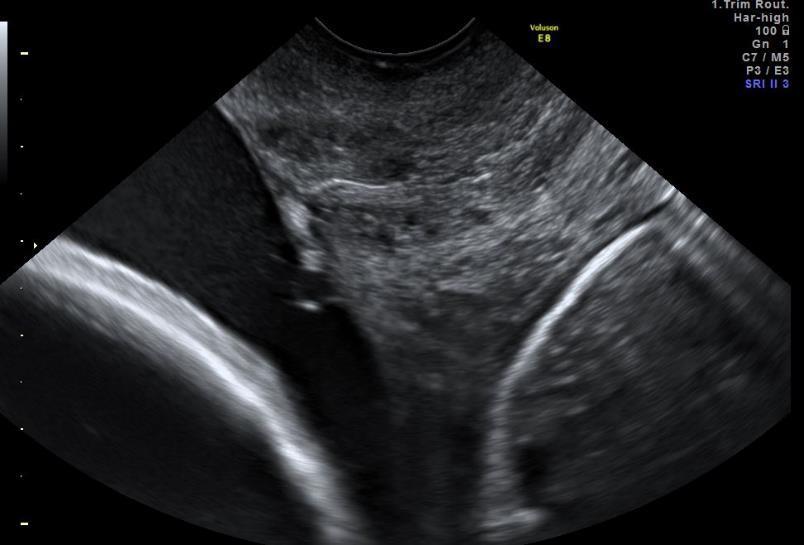 Cervixlengte en placentalokalisatie Placenta Anterior Posterior In fundo Lateraal links/rechts Laag (<20mm) of niet laag?