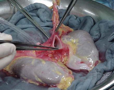 Klinische casus: 2 31-jarige man Hart-longtransplantatie 3 jaar geleden Bronchiolitis obliterans