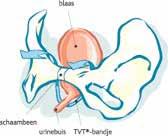 Hoe werkt een TVT-operatie? Bij de TVT-operatie wordt onder de naar beneden gezakte urinebuis met een kunststof bandje gelegd.