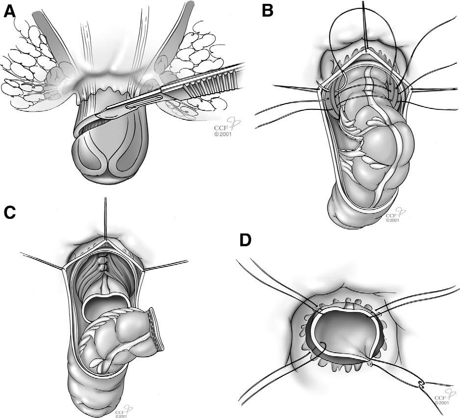 Alternativen LVR Altemeier procedure: Obliterated