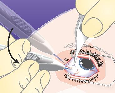 3) Richt de applicator nu op het midden van het oog in de vitreuze holte. Dat zal een zacht hellend traject in de sclera vormen. Duw de naald totdat je in de vitreuze holte binnengaat.