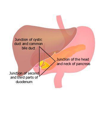 Gastrinoom Algemeen Kleine tumoren (60% pancreas, 30% duodenum)