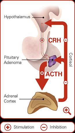 Syndroom Cushing Hypercortisolemie Exogene oorzaak Corticosteroiden gebruik ACTH afhankelijk Ziekte