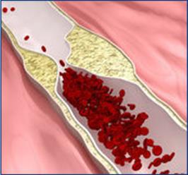 Dit proces begint met een lokale ophoping van bloedplaatjes, bloedcellen en cholesterol in de vaatwand. Deze ophopingen worden plaques genoemd.